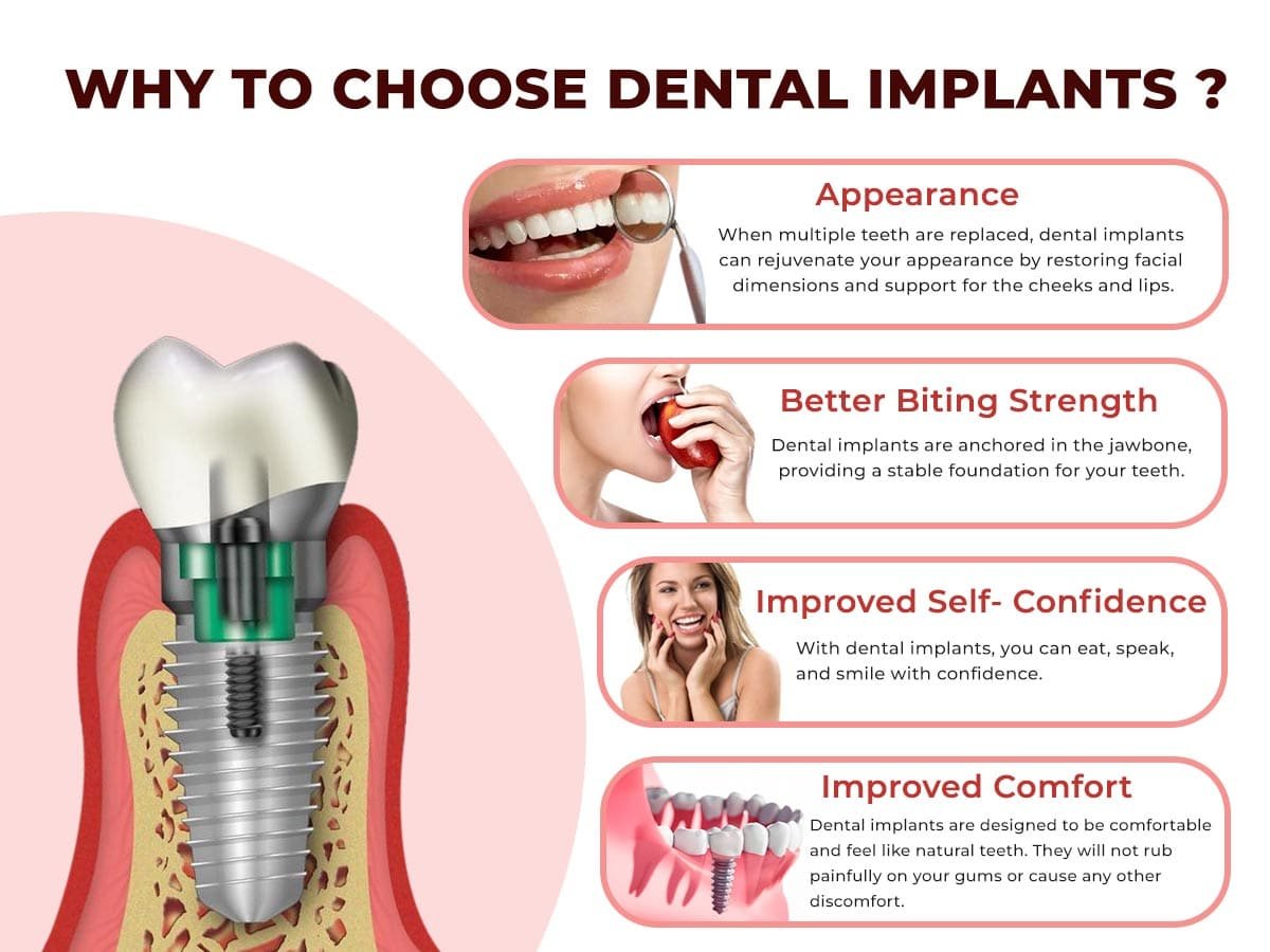 Dental Implants